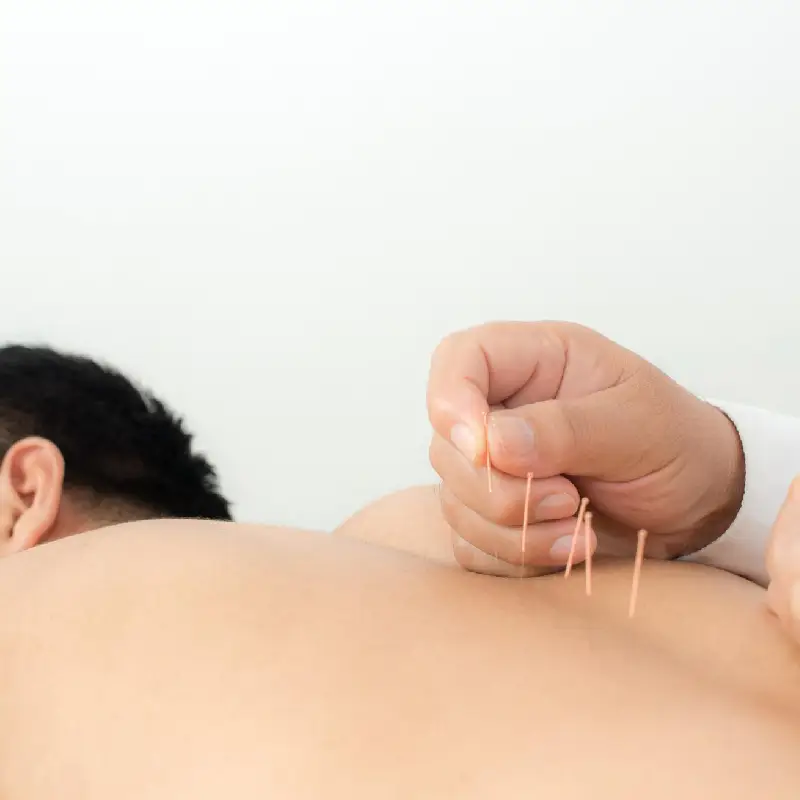 Acupuncture